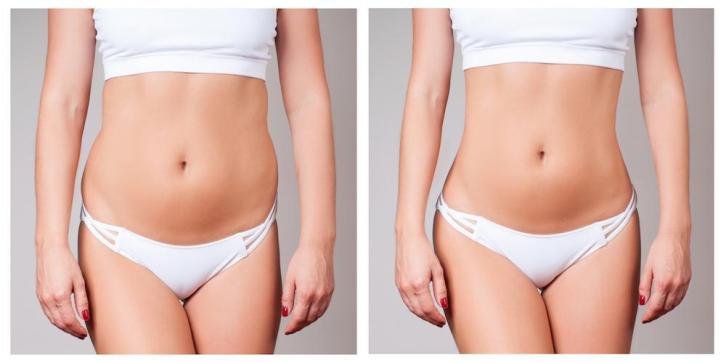 Liposuction